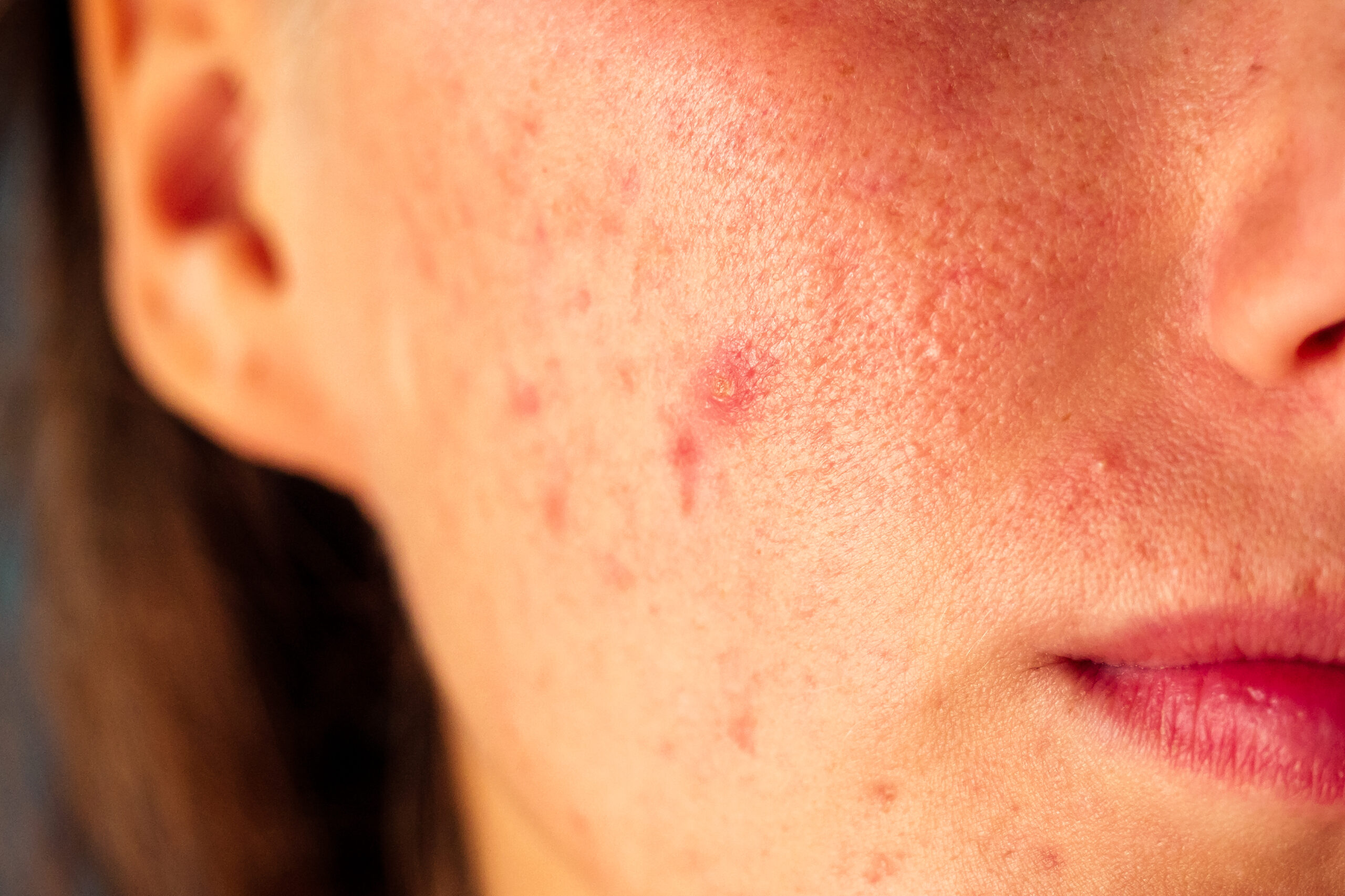 Post-acne,,Scars,And,Red,Festering,Pimples,On,The,Face,Of